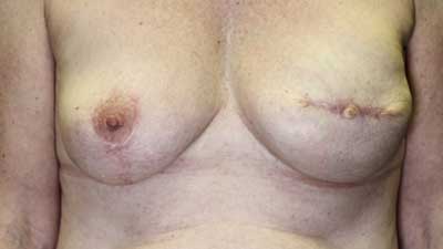 3D areola nipple reconsruction