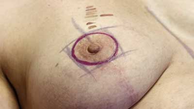 3D areola nipple reconsruction