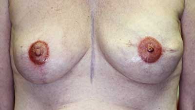 3D areola nipple reconsruction