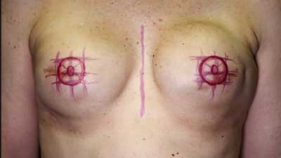 3D areola treatment