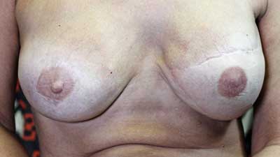 3D areola treatment